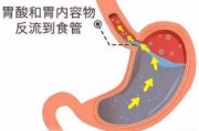 反流性食管炎怎么治返流性食管炎