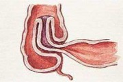 胃里长息肉有什么症状,胃里长息肉