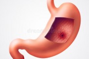 患上胃溃疡的症状是什么？