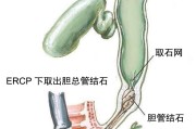 胆管结石,胆管结石怎么能排出来了