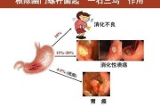 包含感染幽门螺旋杆菌有哪些症状的词条