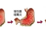 慢性肠胃炎怎么调理饮食慢性肠胃炎
