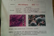 关于幽门螺旋杆菌阳性怎么得的的信息