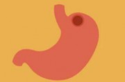 胃癌早期有三处痛胃穿孔症状