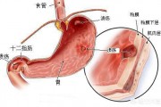 胃溃疡和胃癌的区别是什么？
