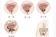 前列腺钙化什么意思有什么影响前列腺钙化什么意思