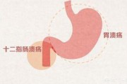 胃溃疡与十二指肠溃疡在临床表现上有哪些异同？