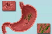 胃癌的早期症状有哪些胃炎和胃溃疡有什么区别