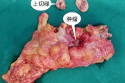 乙状结肠,乙状结肠增厚一般就是癌