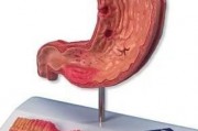 胃溃疡可以根治吗？胃溃疡患者该如何调养？