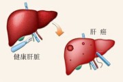 肝癌晚期病人临终前发出的五个信号肝癌晚期病人临终前发出的五个信号, 可惜很少人知道