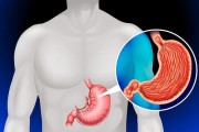 胃癌最明显的一个征兆,胃癌