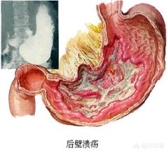 胃炎与胃溃疡有什么区别<strong>胃炎</strong>？