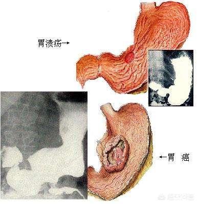 胃炎和胃癌该怎样区分<strong>胃炎</strong>？