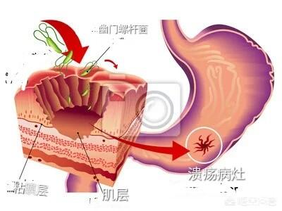 胃溃疡患者要怎样注意饮食呢<strong>胃溃疡</strong>？