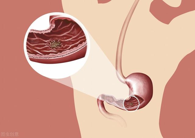 别拿胃溃疡不当大病！这篇胃溃疡科普指南<strong>胃溃疡</strong>，送给你
