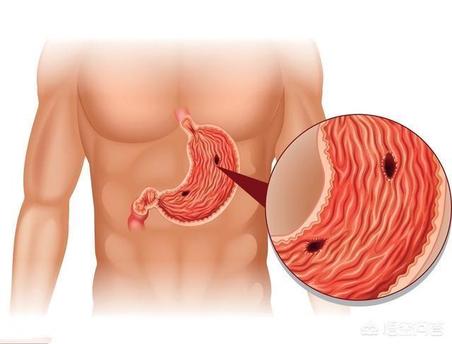 吃饭时的4种迹象<strong>胃溃疡</strong>，说明胃溃疡无疑，再不治疗就是胃癌了！指的是哪4点？