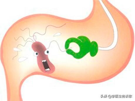 胃溃疡是萎缩性胃炎吗<strong>胃溃疡</strong>？容易癌变吗？