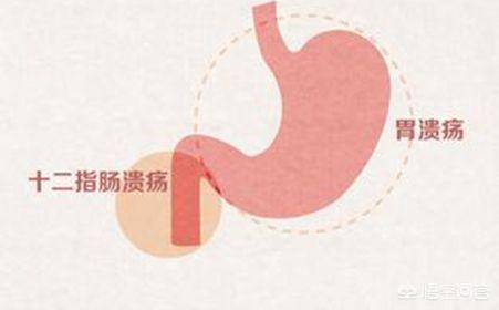 胃溃疡与十二指肠溃疡在临床表现上有哪些异同<strong>胃溃疡</strong>？
