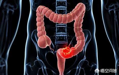十二脂肠溃疡与肠炎有什么区别<strong>肠炎</strong>？