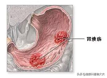 有什么建议可以推荐给有胃病的朋友<strong>胃炎</strong>？