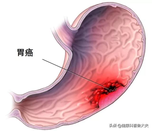 有什么建议可以推荐给有胃病的朋友<strong>胃炎</strong>？