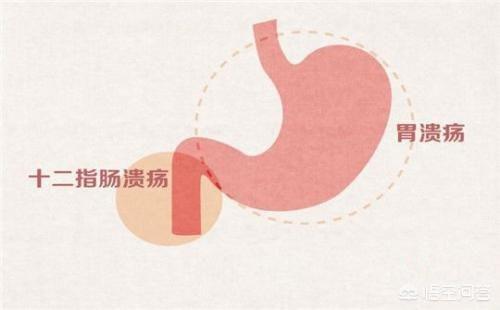 为什么胃和十二指肠溃疡这么常见<strong>十二指肠</strong>？