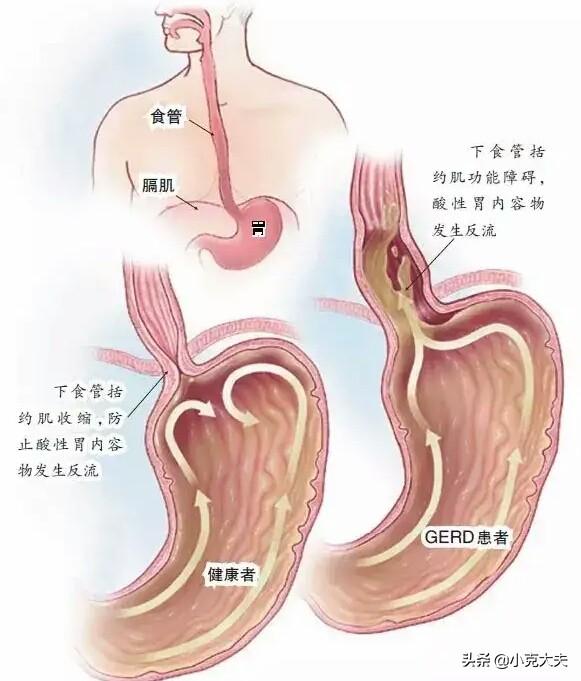 胃痛反酸是如何引起的<strong>胃脘痛</strong>？需要治疗吗？