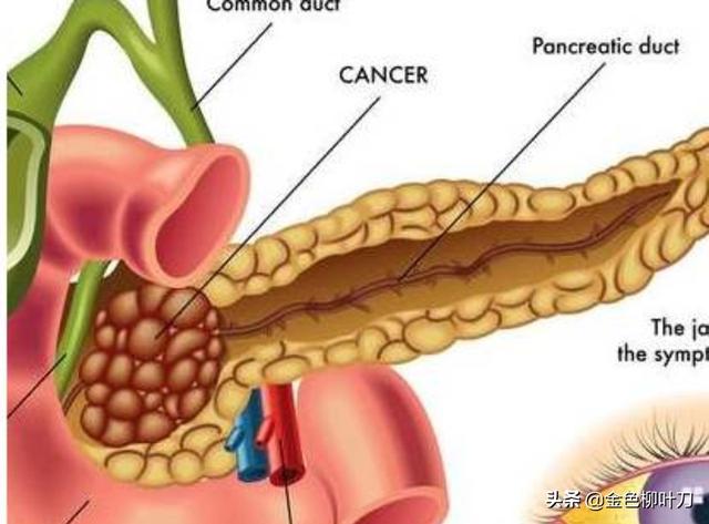 胰腺癌一般哪里会出现疼痛<strong>十二指肠</strong>？