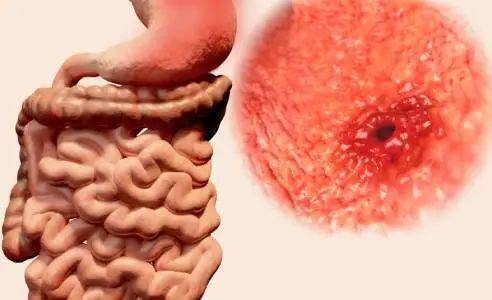 胃溃疡症状表现有哪些胃溃疡症状表现有哪些用什么药