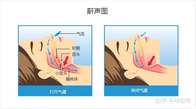 打鼾是因为什么腺体肥大打鼾是因为什么