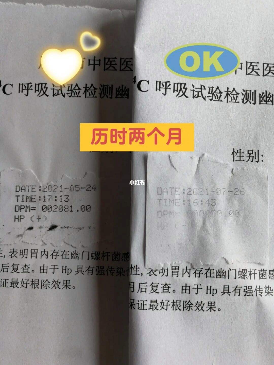 幽门螺旋杆菌怎么检查幽门螺旋杆菌怎么去医院检查