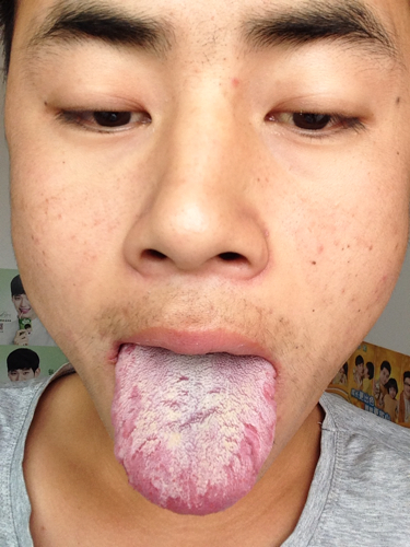 舌苔发黄厚是什么原因,舌苔黄厚腻是什么原因造成的