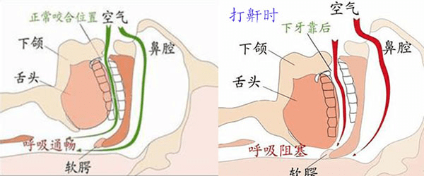 睡觉打鼾有什么治疗方法睡觉打鼾有什么治疗方法可以缓解