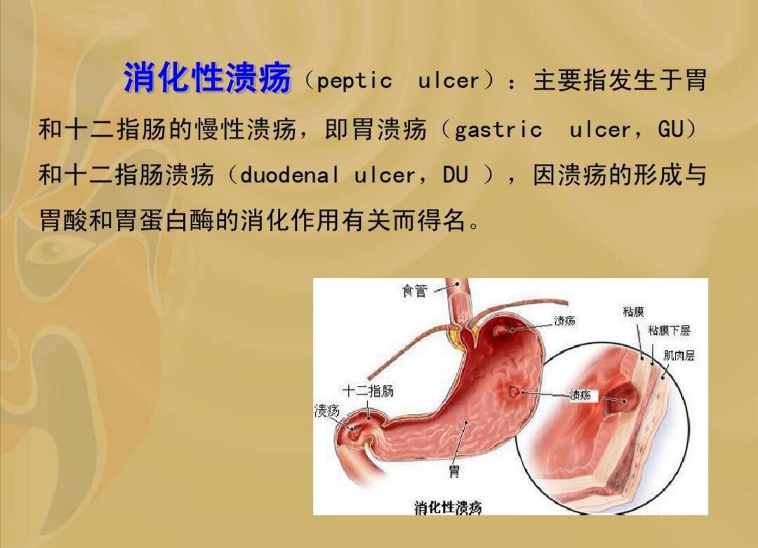 十二指肠溃疡的治疗药物十二指肠溃疡的治疗