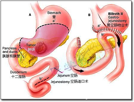 胆汁反流性胃炎,胆汁反流性胃炎症状表现有哪些