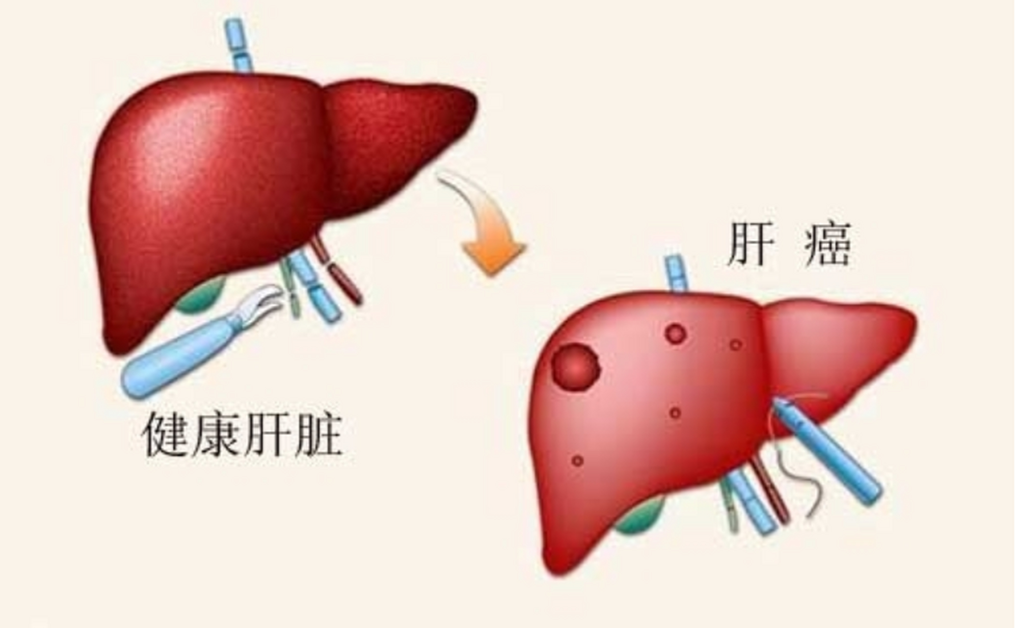 肝癌晚期病人临终前发出的五个信号肝癌晚期病人临终前发出的五个信号, 可惜很少人知道