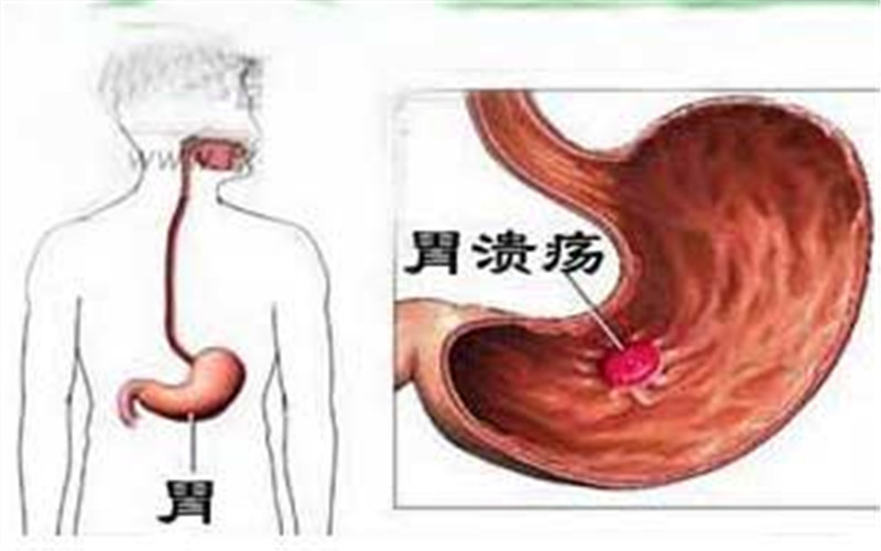 胃溃疡的症状及治疗方法,胃溃疡的症状及治疗