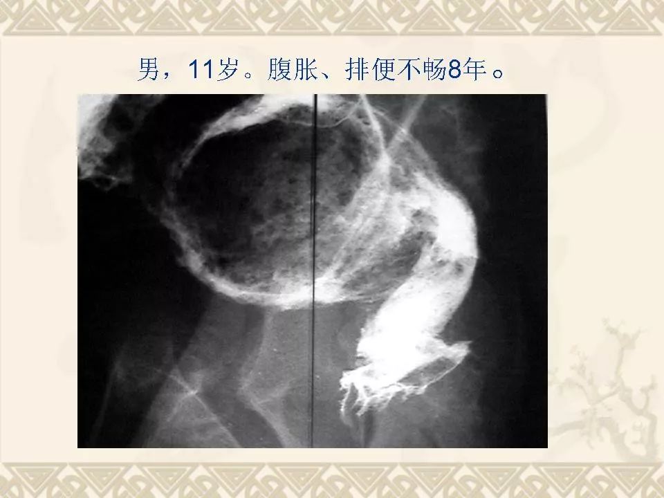 先天性巨结肠b超能检查出来么先天性巨结肠