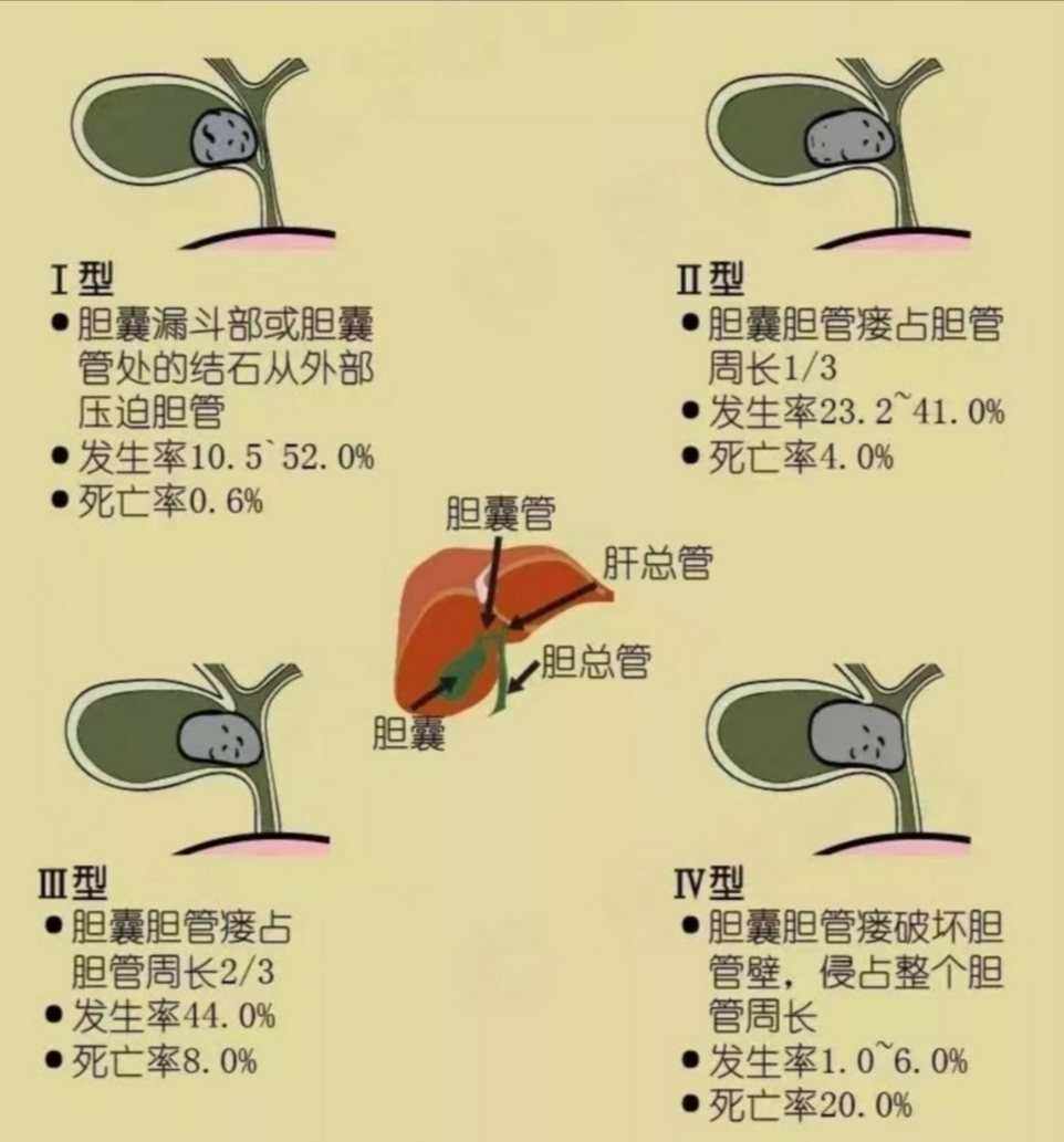 肾结石有哪些症状出现男性胆结石有哪些症状出现