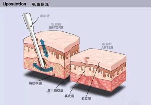 减肥抽脂手术,减肥抽脂手术怎么做