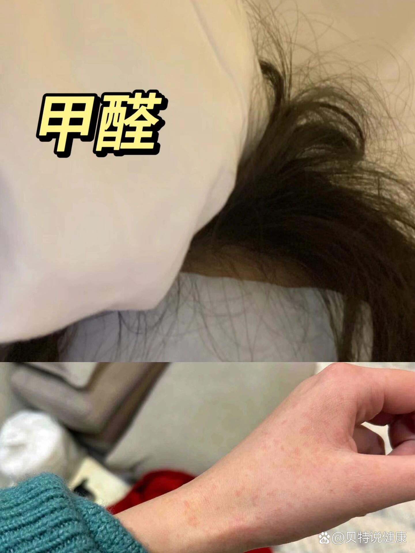 甲醛对人体危害有哪些,甲醛对人体危害有哪些表现