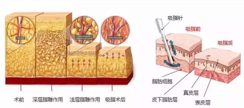 专业吸脂减肥瘦身正规吸脂减肥