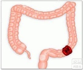 急性肠胃炎禁止喝水急性肠胃炎有些什么症状