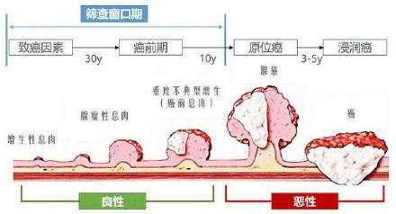 肠癌早期症状,警惕肠癌早期四大征兆