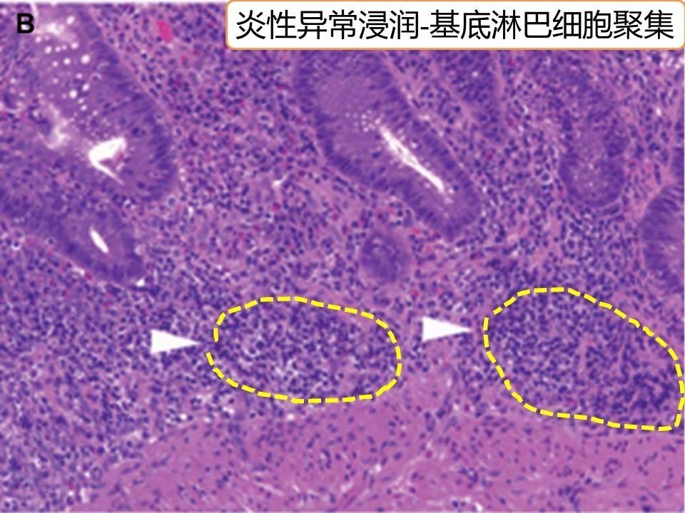 溃疡性结肠炎终身忌口溃疡性结肠炎