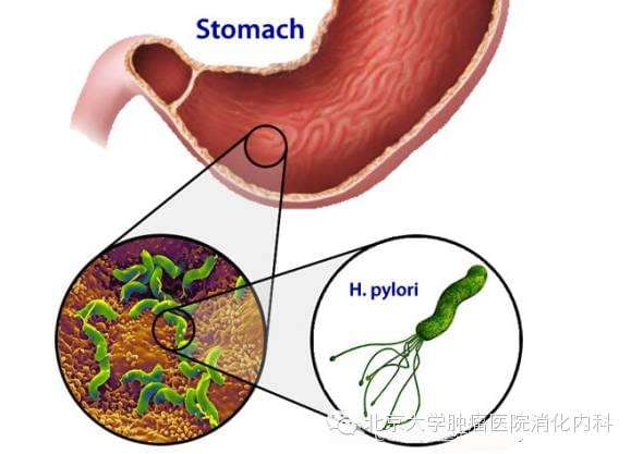 幽门螺旋杆菌阳性有必要治疗吗国外的简单介绍
