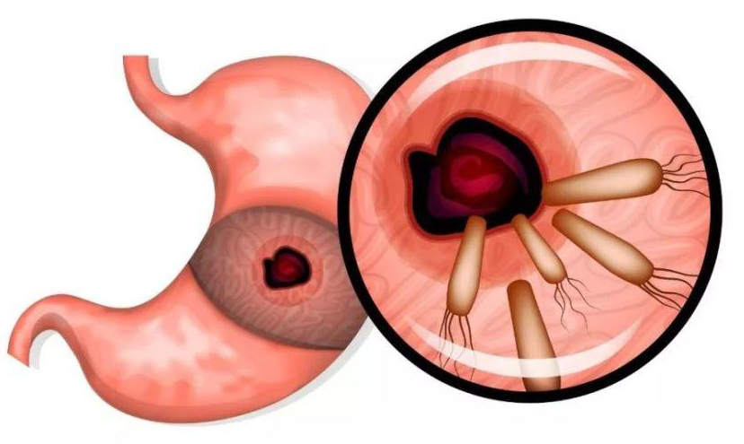 教你几招自测幽门螺杆菌幽门螺旋杆菌的症状
