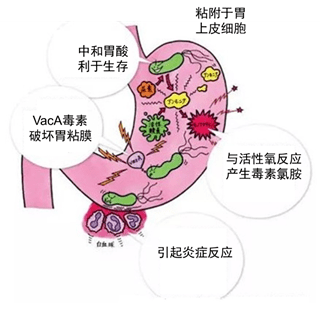 幽门螺旋杆菌阳性一个加号严重吗,幽门螺旋杆菌的症状阳性