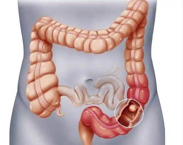 结肠癌早期症状,结肠